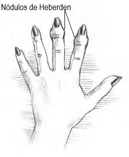 que es la osteoartritis manos